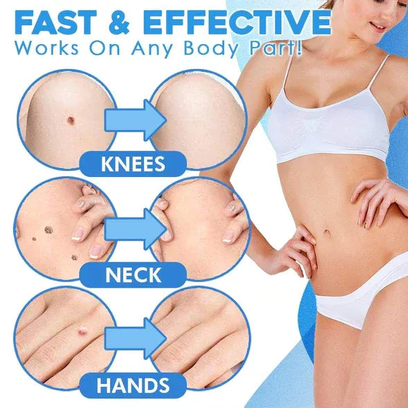 Mole Removal
