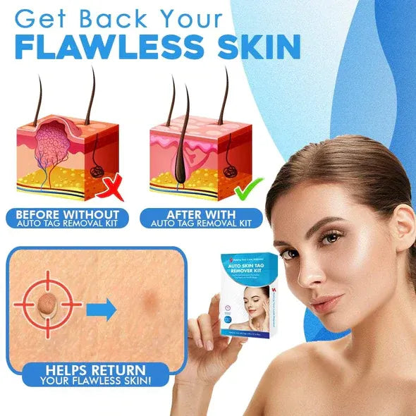Mole Removal