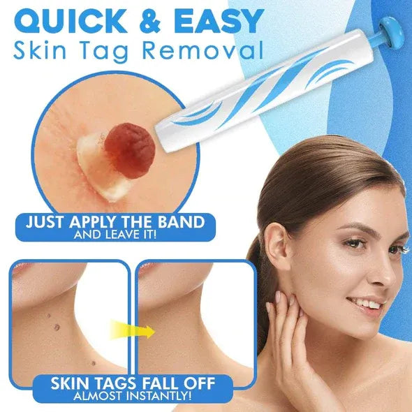 Mole Removal